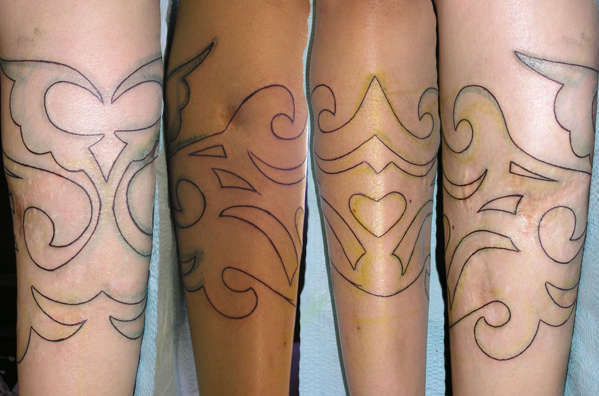 Scar_cover_up_line_work